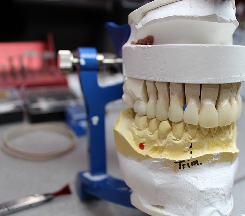 10 e-max crns and veneers 006.jpg